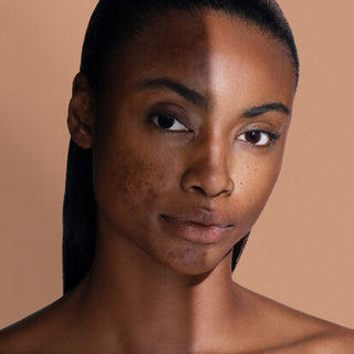 Post-inflammatory hyperpigmentation (PIH) treatment guide