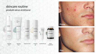 anclean®  -procedure for correcting problematic, acne-affected skin