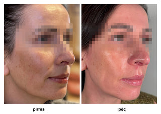 cosmelan® - a treatment for hyperpigmentation and dark spot correction.