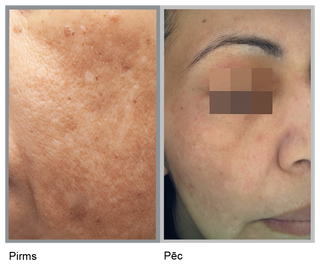 cosmelan® - a treatment for hyperpigmentation and dark spot correction.